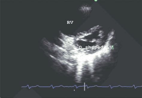 d shaped lv|d shaped septum diagram.